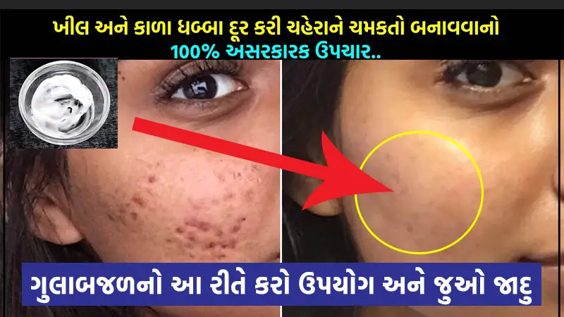 ખીલ અને કાળા ધબ્બા